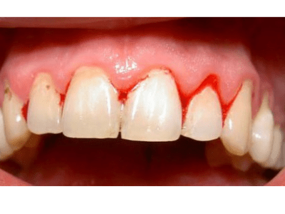 Bệnh Về Nướu Răng (Gum&nbsp;Disease)